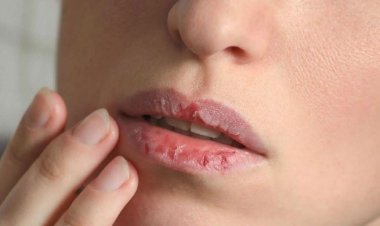 গরমকালে ঠোঁট ফাটলে মিলবে ৬ উপায়ে সমাধান!