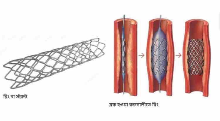 ফের বাড়ছে হার্টের রিংয়ের দাম