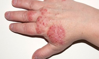 স্ক্যাবিস কী? লক্ষণ, প্রতিরোধ এবং চিকিৎসা